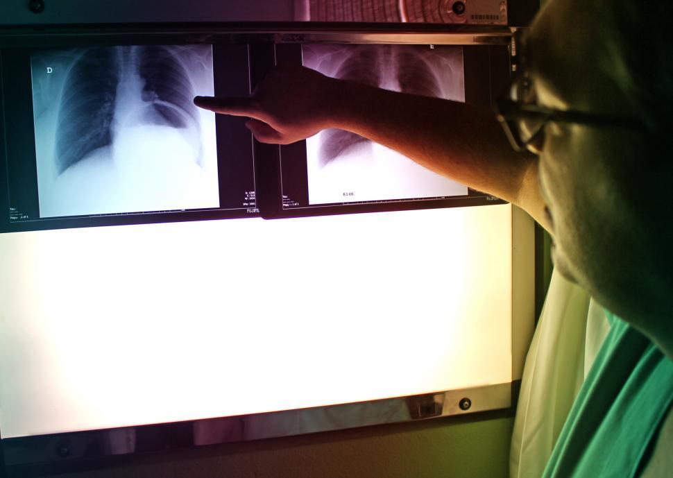 Free Image of Doctor Pointing to X-Ray Picture - Chest PA Radiography 