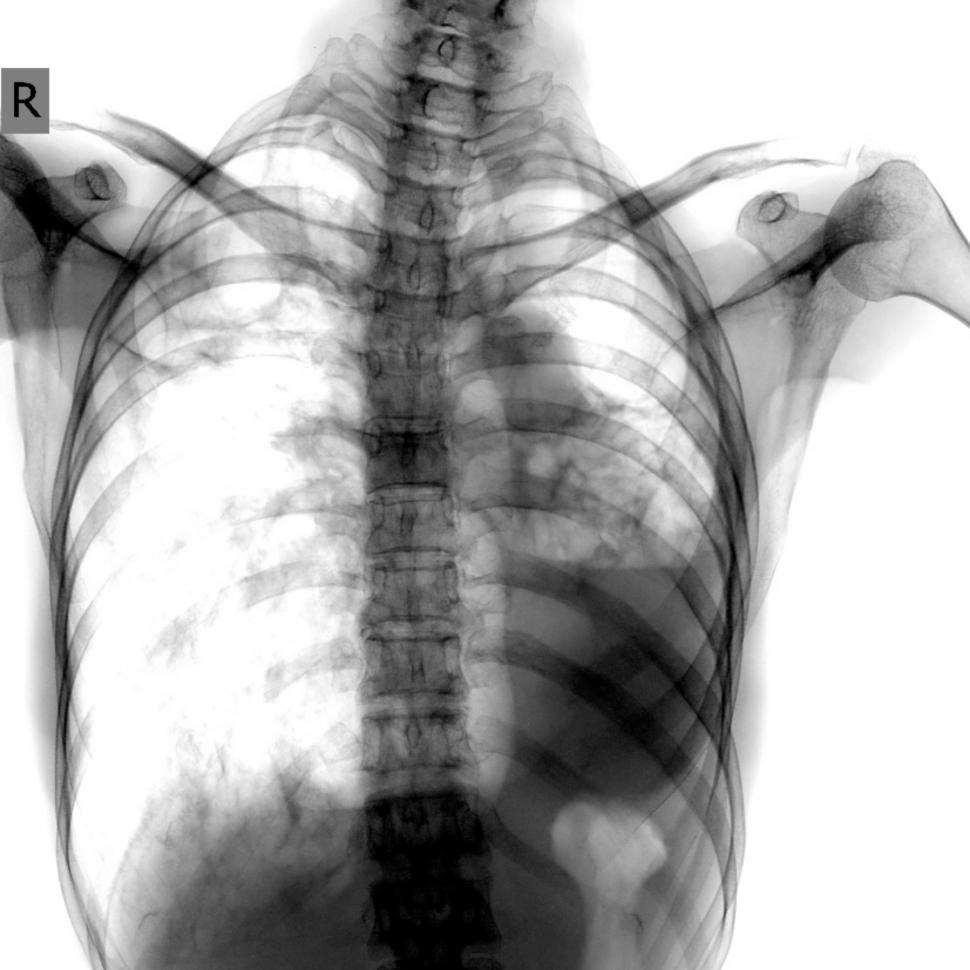 Free Image of X ray chest radiology from medical check up  