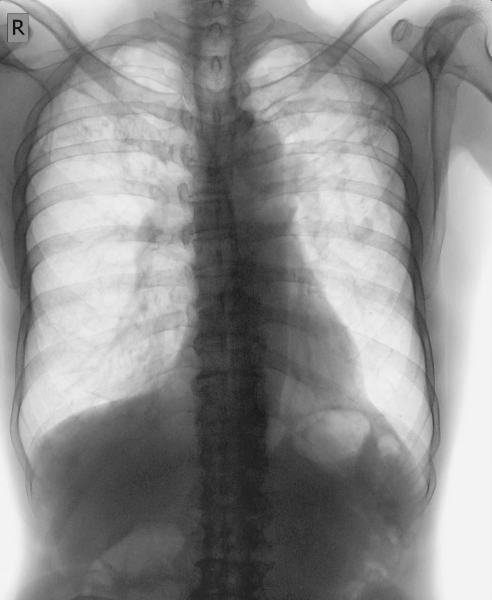 Free Image of A human chest x ray radiology from medical check up  
