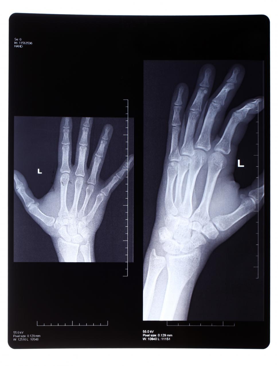 Free Image of Xray of a Hand 