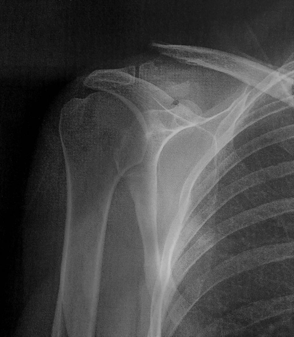 Free Image of Bone fracture of the collarbone  