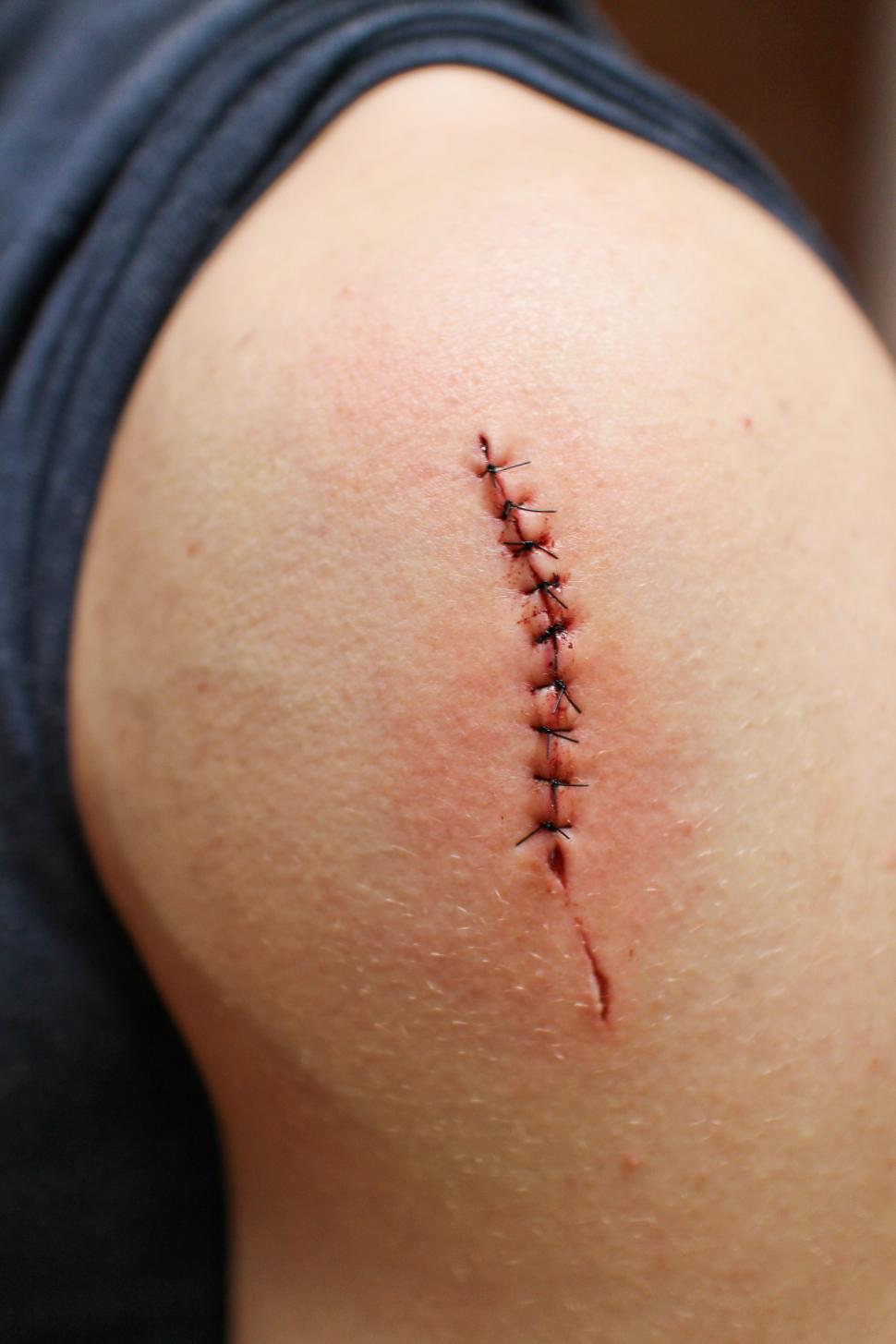 Free Image of Stitches on wound 