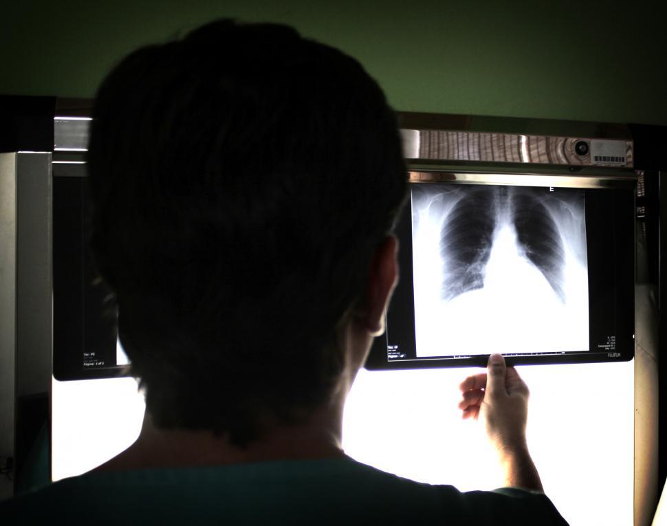 Free Image of Medical doctor examining a chest PA x-ray image 