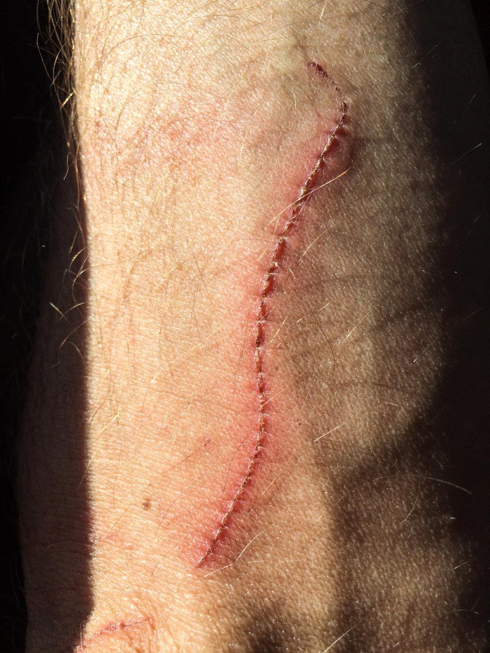 Download Free Stock Photo of Healing wound on arm 